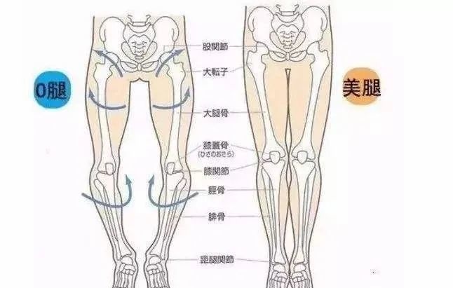 o型腿难看又影响生活,除了做手术真的没有别的办法吗?