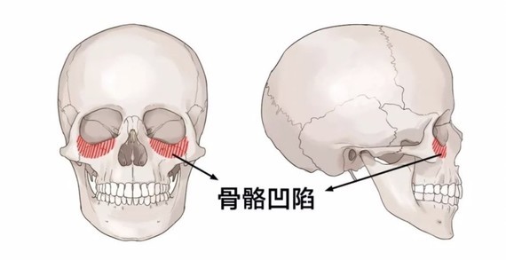 有些人眼下这块骨头特别的后缩,所以这些人的脸很平,没有苹果肌.