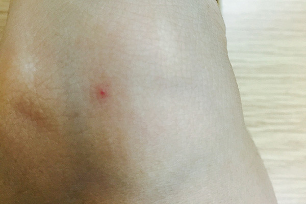 皮肤上有蜘蛛痣代表肝不好了先别慌医生教您如何辨别