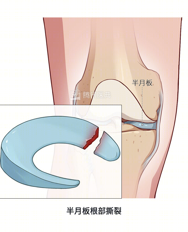 让篮球运动员报销的半月板撕裂究竟是怎么回事