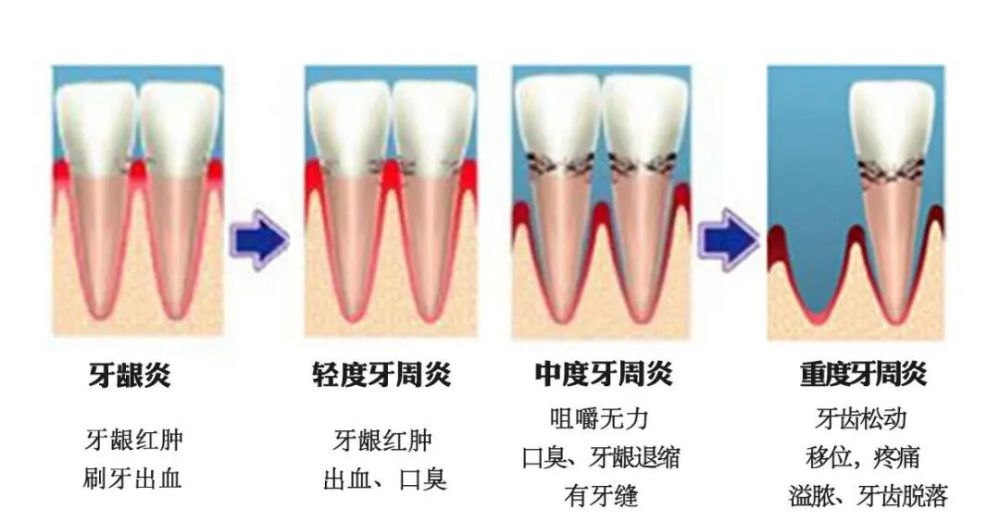 牙周炎病变过程及刮治,3d动画演示