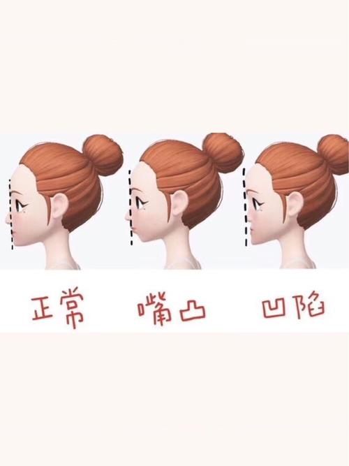不过需要注意的是,鼻基底凹陷会伴随有嘴凸现象,但是发生"嘴凸"并不