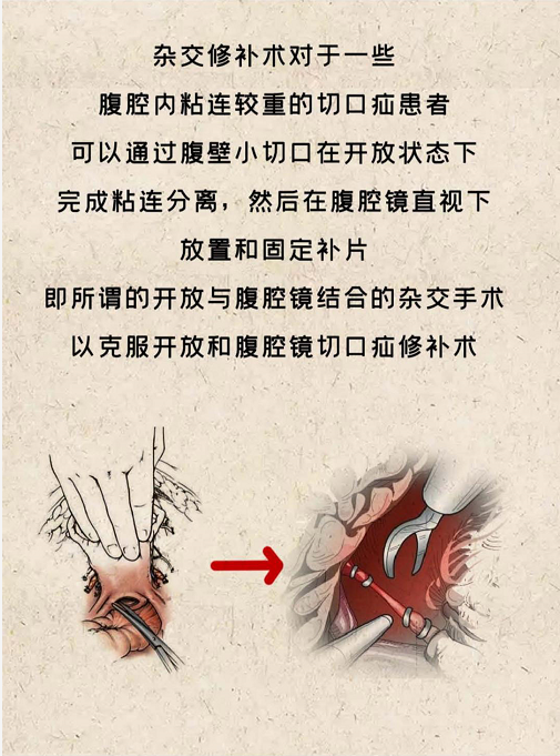 疝病专家董擂带你了解腹壁切口疝的治疗