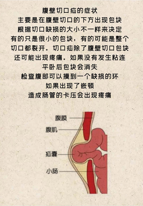 疝病专家董擂带你了解腹壁切口疝的治疗