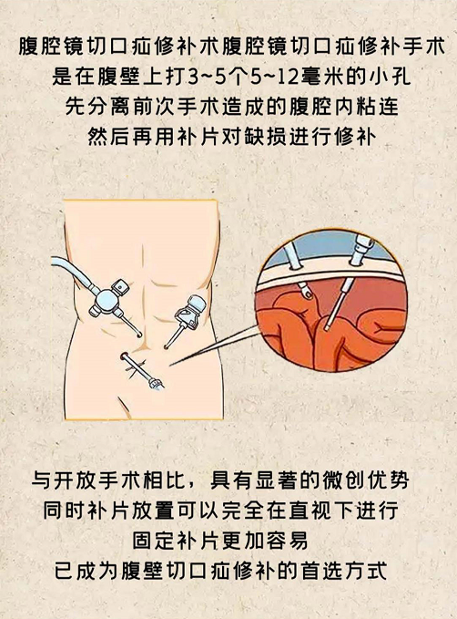 疝病专家董擂带你了解腹壁切口疝的治疗