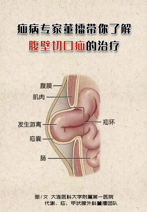 疝病专家董擂带你了解腹壁切口疝的治疗