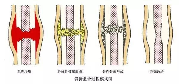 (2)血肿逐渐机化,外膜处开始形成骨样组织 原始骨痂形成期(4~8周) (1