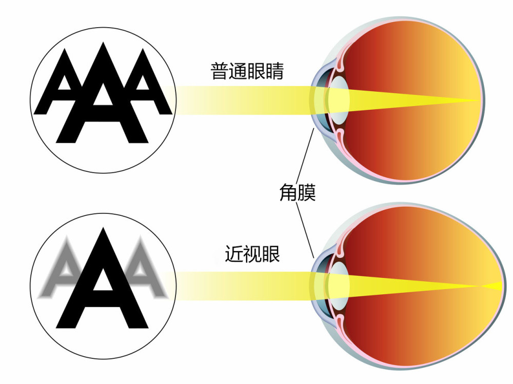 我国近视人口_预防近视手抄报(3)
