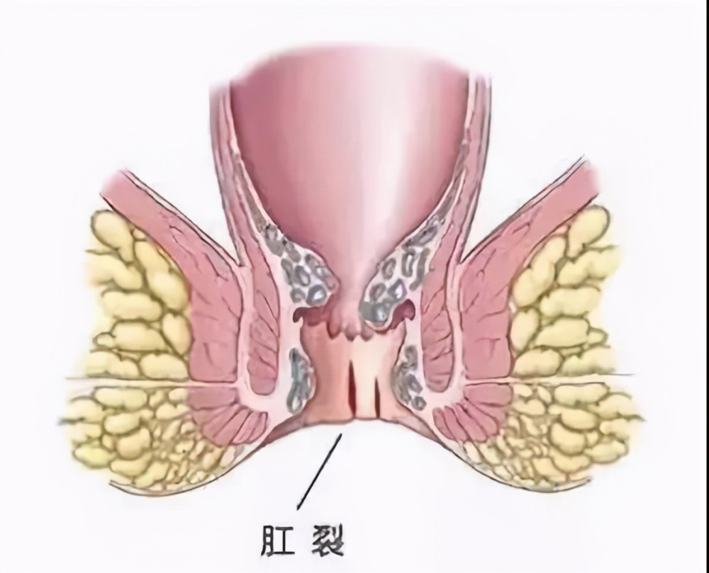 肛裂有急性和慢性之分,慢性肛裂由于病程长和反复发作,裂口上端的肛门
