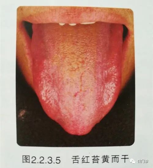 舌头红,舌苔黄,舌尖疼,两味药化解!很实用的老方子