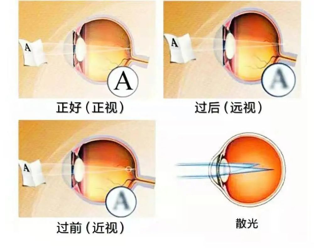 究竟什么是屈光不正?