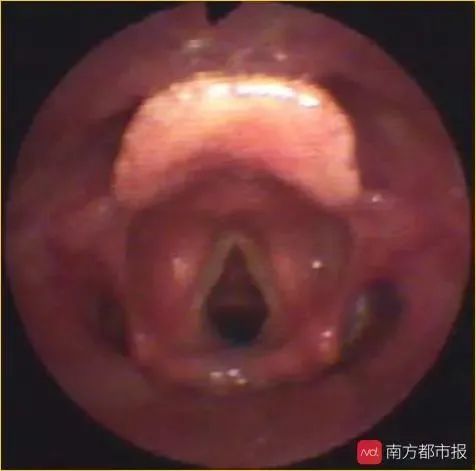 该病起病突然,发展迅速,以会厌高度水肿引起的剧烈咽喉痛,吞咽和呼吸