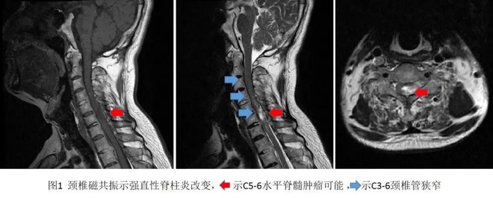 当强直遇上脊髓肿瘤神经外科医师挑战硬碰硬