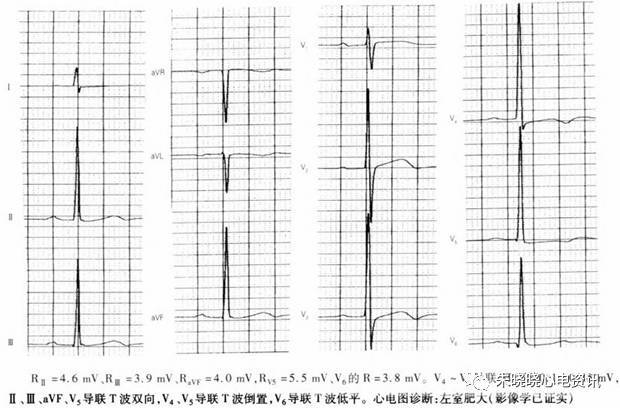 【临床意义】高血压患者出现明确左心室肥大心电图改变者,病死率高于