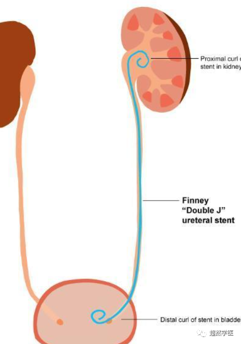 一文了解输尿管支架管(双j管)和kub