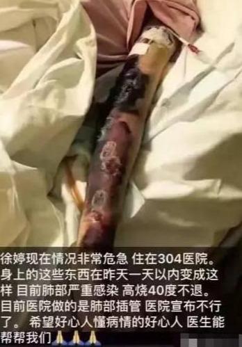 最美演员徐婷被全家吸血五年26岁患癌全身溃烂死在北京