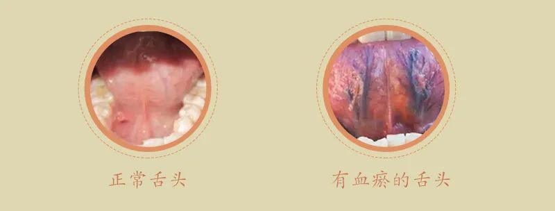 舌头出现这种颜色斑点警惕心脑血管疾病教你望舌识血瘀