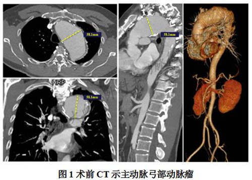 增强ct示:a型主动脉夹层近端修复术后,主动脉弓部巨大动脉瘤形成,最大