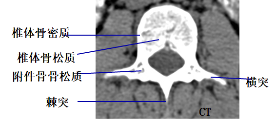 收藏贴|颈椎,腰椎ct常见病变,你都了解吗?