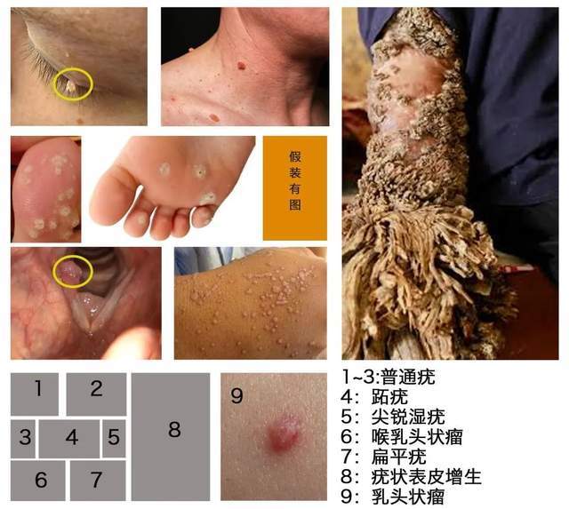 hpv引起的各种皮肤或黏膜疣状病变
