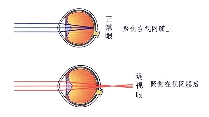 远视眼其实更容易视疲劳