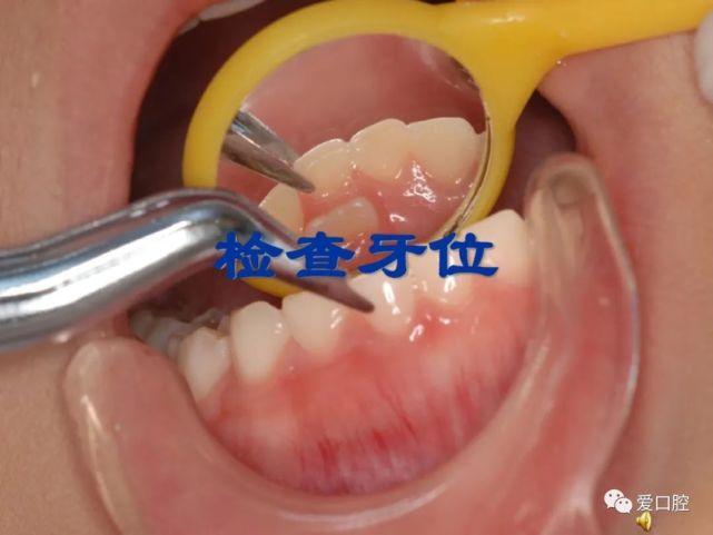 口腔乳牙的拔除术