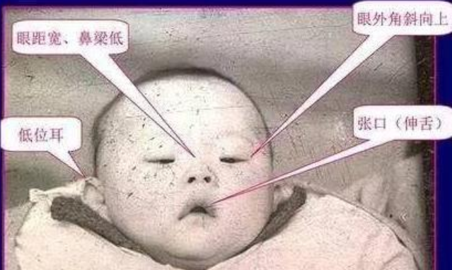 患有"唐氏综合征"的宝宝,面部特征很明显,婴儿阶段就能看出来