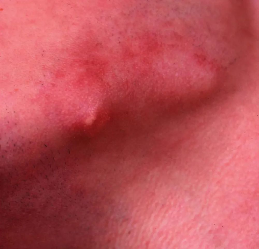 熟悉皮肌炎的皮肤改变,少一些误诊(下)_腾讯新闻