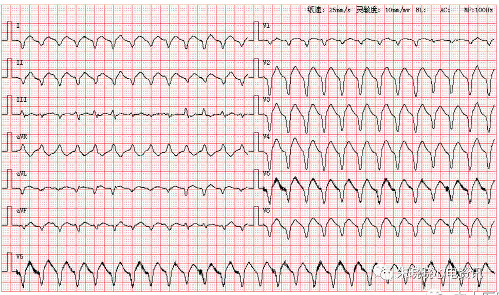 每日读图第1290期室性心动过速