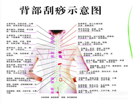 刮痧的部位选择:常选取足太阳膀胱经背部穴位及督脉刮痧后部位出现的