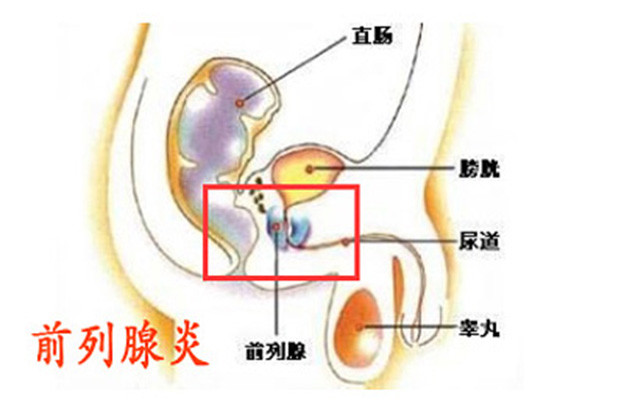 热水坐浴对前列腺炎有治疗作用吗?