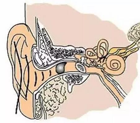 外耳道胆脂瘤怎么形成的