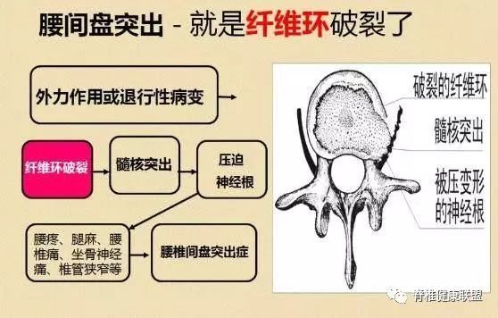 腰椎间盘突出多,坐骨神经痛?怎么保养,养护是关键!