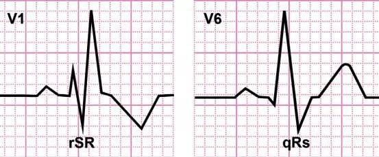 干货|缓慢性心律失常急症的临床和心电图特点及处理