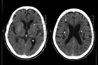 教你分清脑供血不足腔隙性脑梗死脑血栓和脑梗死