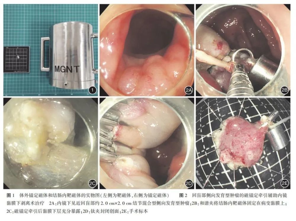【病例报道】磁锚定牵引辅助内镜黏膜下剥离术治疗回盲部侧向发育型