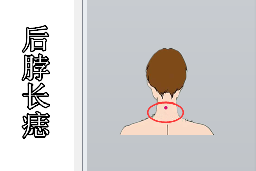 身上5颗"福禄"痣,越黑运越旺,一个生财,一个升官,皇帝