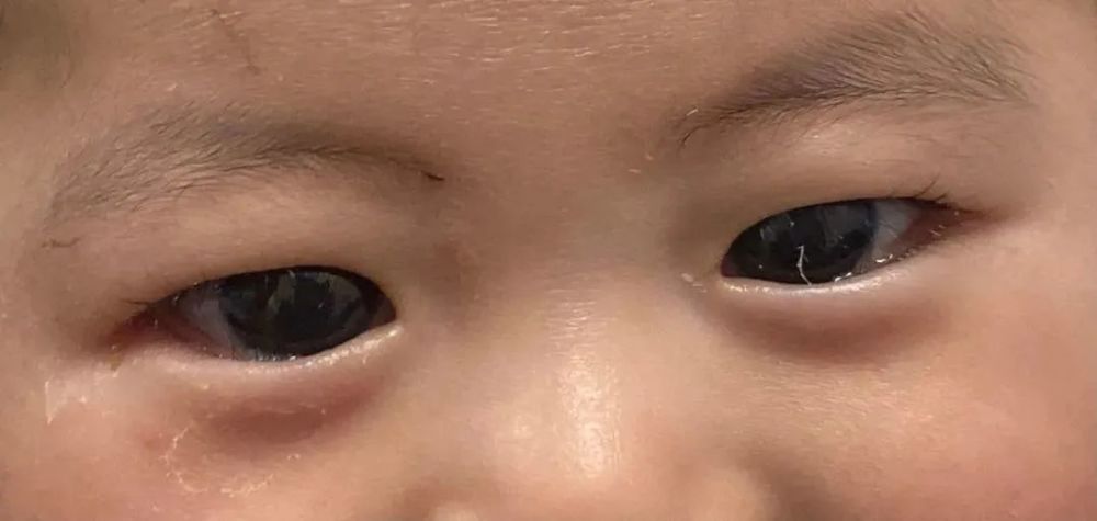 第二天拆开纱布后,家长们惊喜地发现,宝宝的眼睛 变亮了,黑眼珠大小