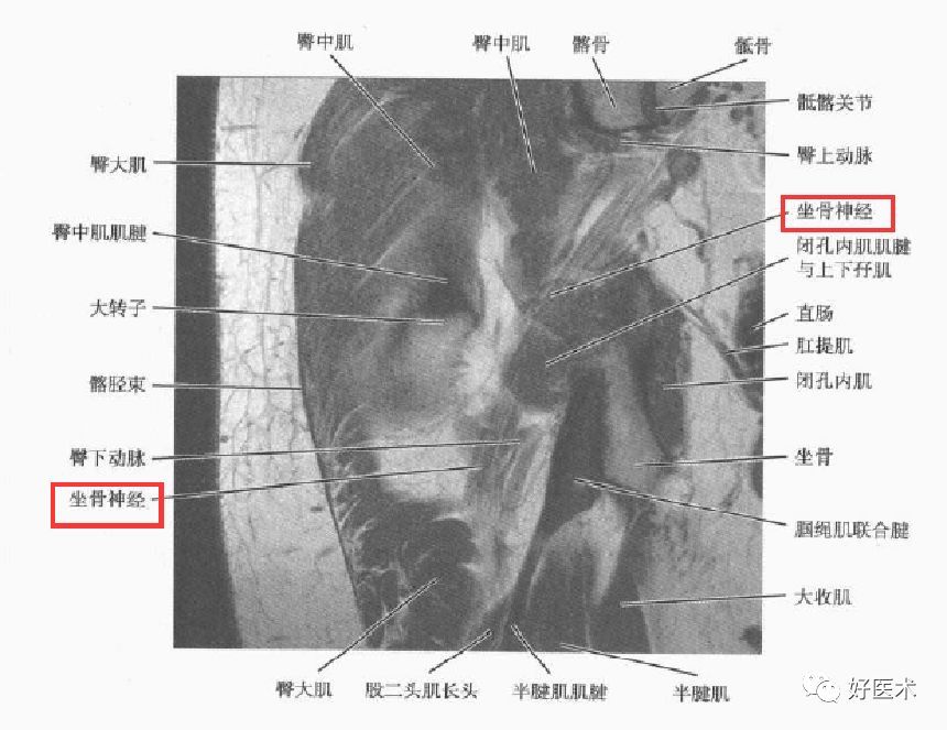 3,梨状肌周围断层解剖2,梨状肌周围结构坐骨神经是人体最粗大的神经