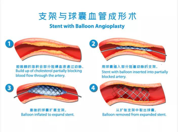 23"百元"冠脉球囊落地东莞|球囊|冠脉|冠脉支架