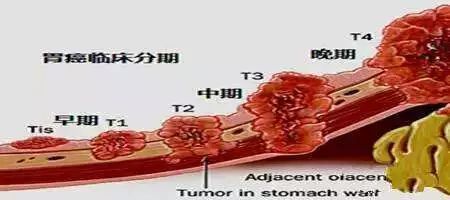 晚期胃癌,指肿瘤已穿透浆膜层并有淋巴结转移,或已累及邻近组织器官等