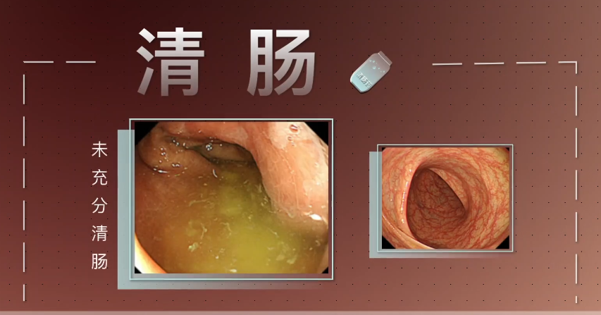 肠镜检查前为什么要做肠道准备?肠道准备就是喝泻药?