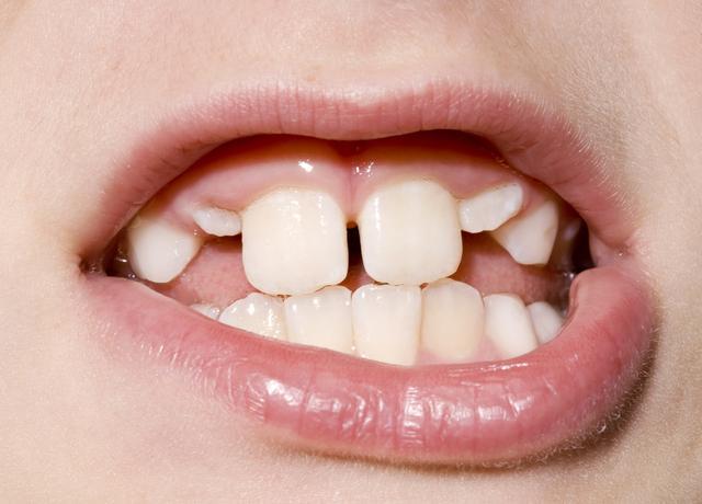 儿童牙齿拥挤可以矫正吗?