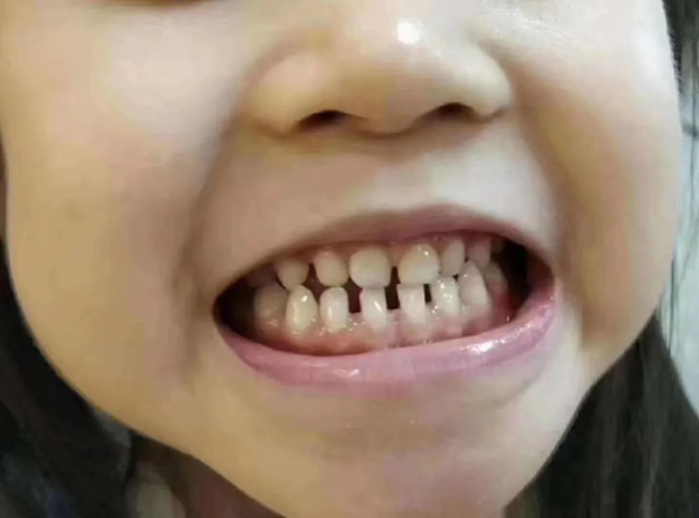 如果发现孩子 牙齿间的缝隙变大了,也说明他们颌骨发育得不错,平时