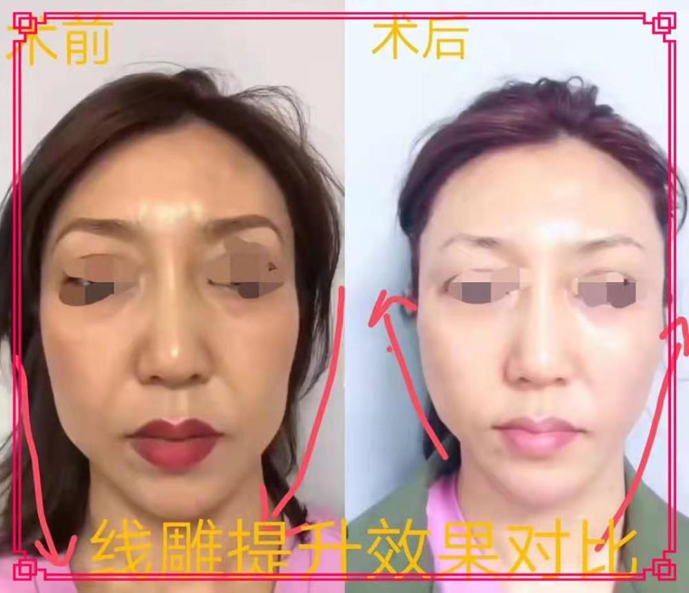 看婆婆线雕恢复期真实图片听耿直的小美说(提线盾)吃多久提升效果