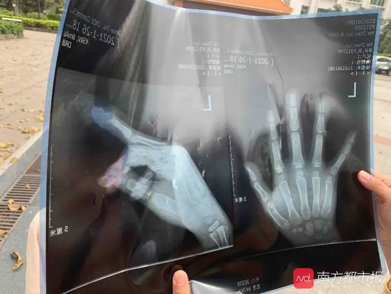 8岁男童大学校园内骑车摔倒,手指骨折!家长:学校应负责