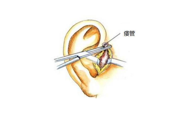 医生提醒:孩子耳朵上有这个小洞要小心