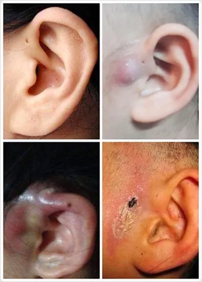 二,手术摘除是唯一有效的治疗方法 先天性耳前瘘管一旦出现过感染,便