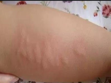 荨麻疹为什么晚上严重?