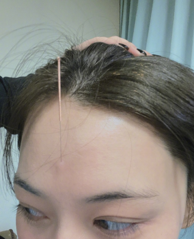 张馨予的针灸画面着实扎心,眉心被插进一枚针,皮肤鼓起小包,那么长的